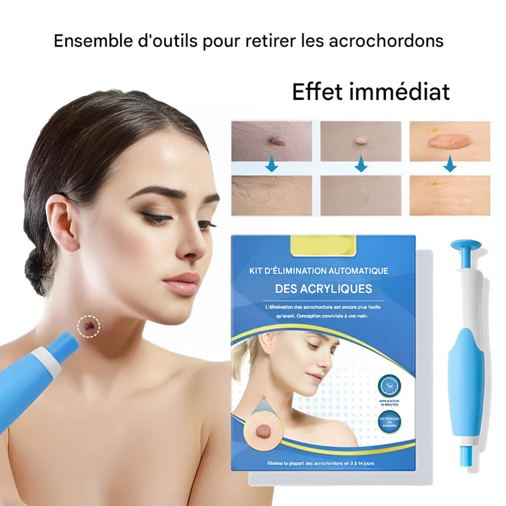 Zestaw do krioterapii brodawek skórnych, zawiera 2 urządzenia, kompaktowy i łatwy w użyciu, do szybkiego usuwania w domu.