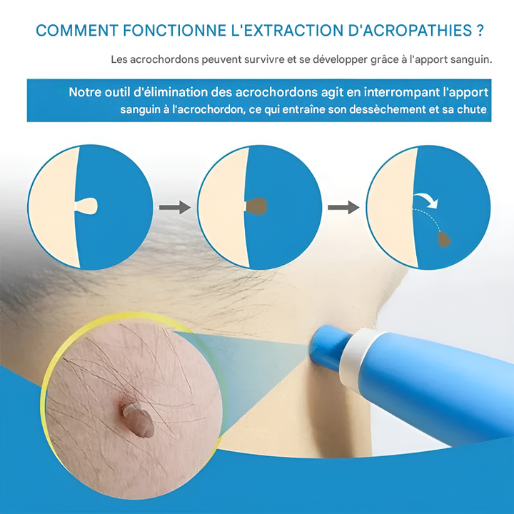 Zestaw do krioterapii brodawek skórnych, zawiera 2 urządzenia, kompaktowy i łatwy w użyciu, do szybkiego usuwania w domu.